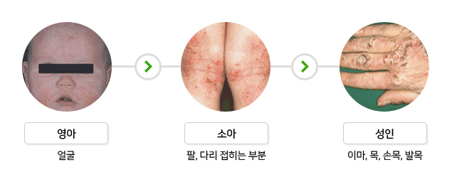 연령에 따른 발생부위 변화