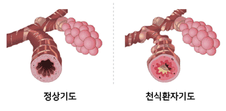 정상기도와천식환자기도