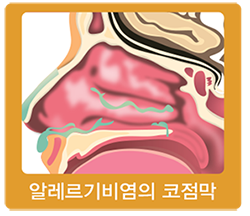 알레르기비염의 코점막
