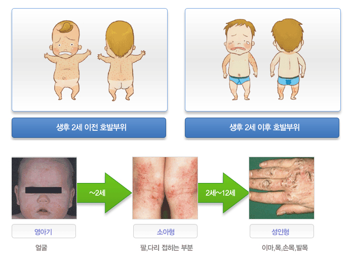 연령에 따른 발생부위 변화 - 영아기:얼굴 / 소아형:팔,다리 접히는 부분 / 성인형:이마,목,손목,발목